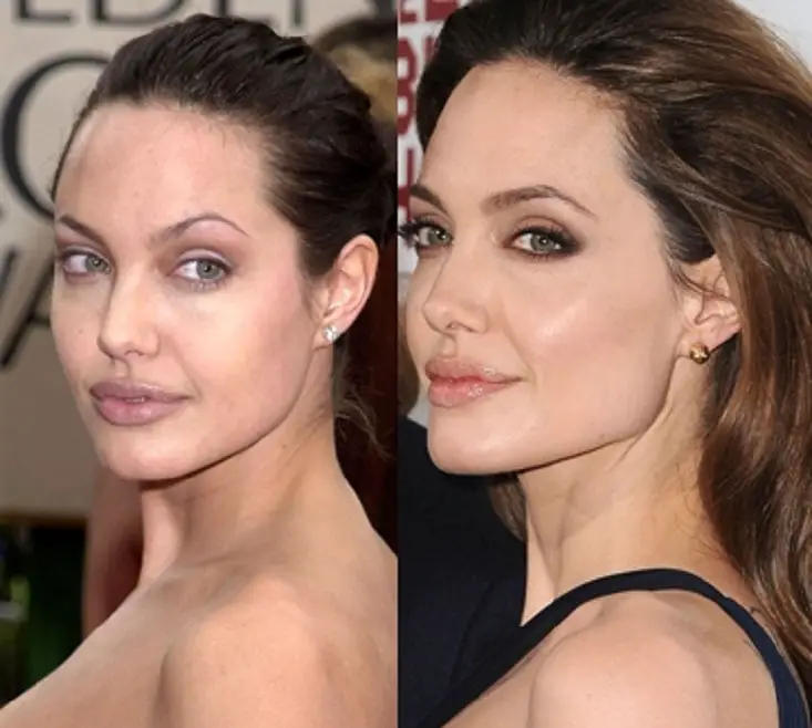 Angelina Jolie Plastic Surgery Before and After Celebie