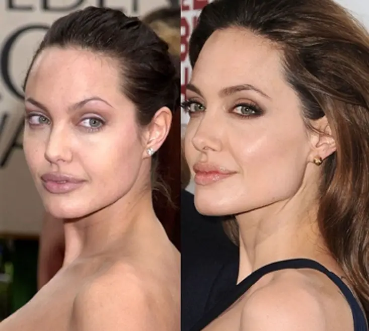 Angelina Jolie Plastic Surgery Before And After Celebie 