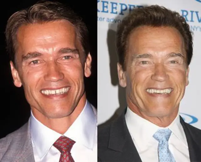 Arnold Schwarzenegger Plastic Surgery Before and After