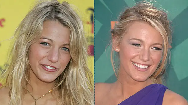 Blake Lively Nose Job Plastic Surgery Before and After