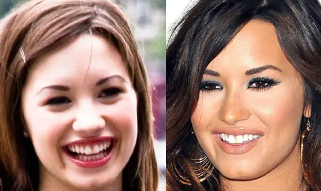 Demi Lovato Nose Job Plastic Plastic Surgery Before and After