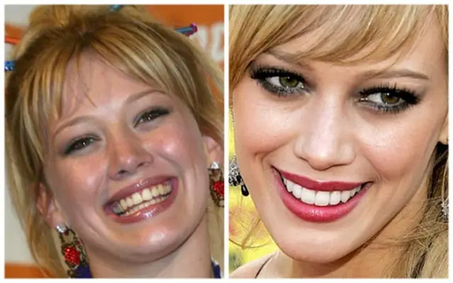 Hilary Duff Plastic Surgery Before and After