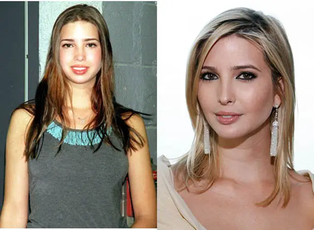 Ivanka Trump Nose Job Plastic Surgery Before and After