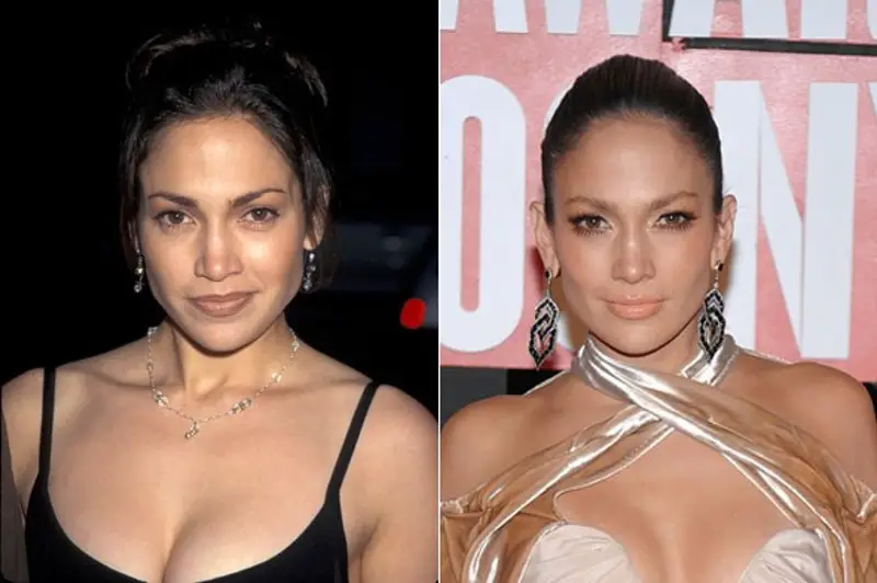 Jennifer Lopez Plastic Surgery Before and After
