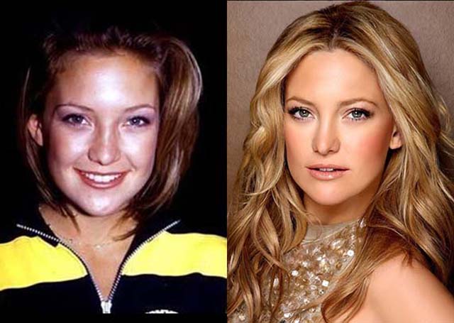Kate Hudson Nose Job Plastic Surgery Before and After