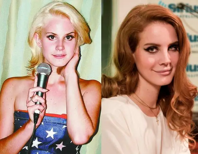 Lana Del Rey Plastic Surgery Before and After