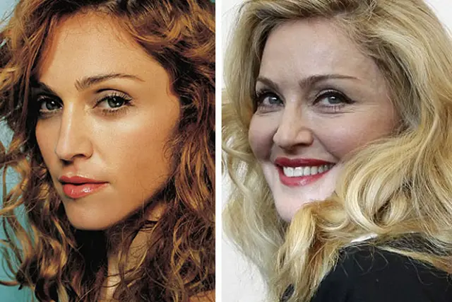 Madonna Plastic Surgery Before and After
