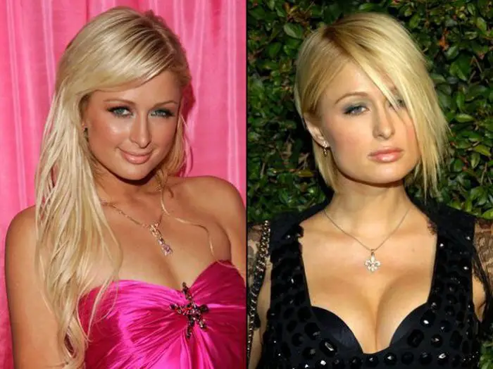 Paris Hilton Nose Job Plastic Surgery Before and After