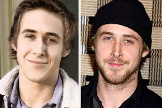 Ryan Gosling Plastic Surgery Before and After