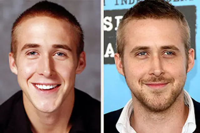 Ryan Gosling Plastic Surgery Before and After