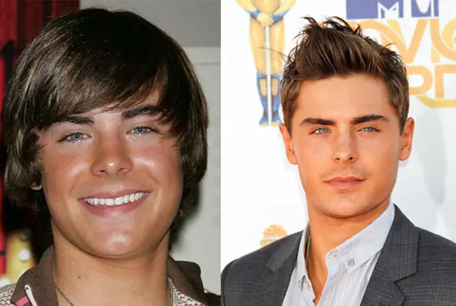 Zac Efron Chin Iimplant & Nose Job Plastic Surgery Before and After