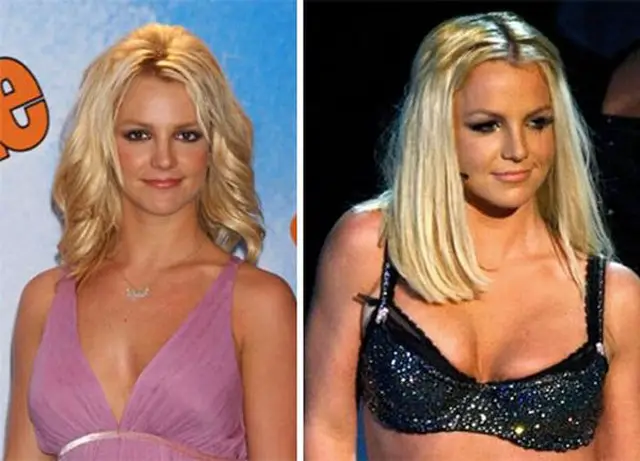 Britney Spears Liposuction