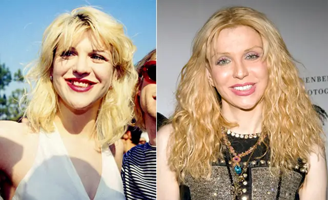 Courtney Love Nose Job Plastic Surgery Before and After
