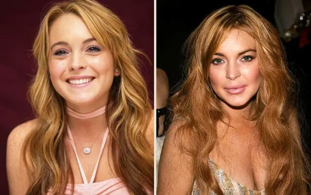 Lindsay Lohan Lip Augmentation Plastic Surgery Before and After