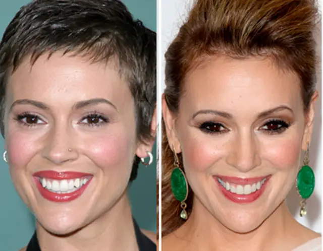 Alyssa Milano Plastic Surgery Before and After Botox Injections