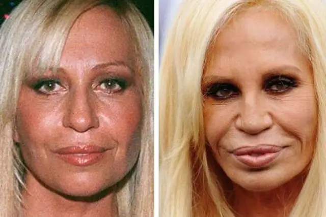 Donatella Versace Facelift Plastic Surgery Before and After