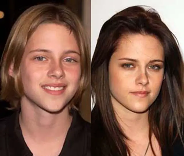 Kristen Stewart Plastic Surgery Before and After