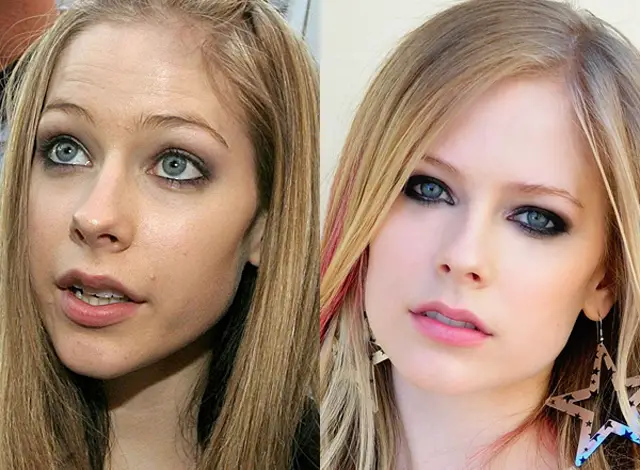 Avril Lavigne Nose Job Plastic Surgery Before and After