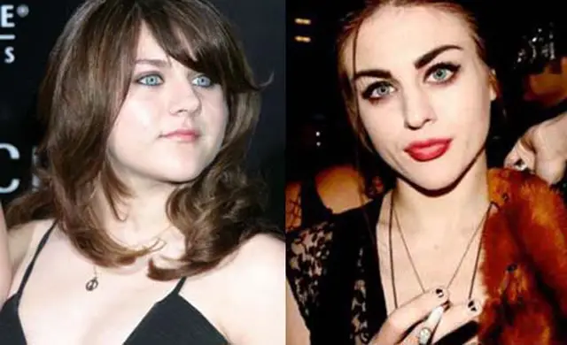 Frances Bean Cobain Nose Job Plastic Surgery Before and After