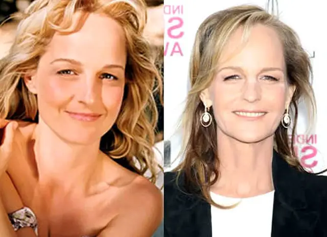 Helen Hunt Facelift Plastic Surgery Before and After