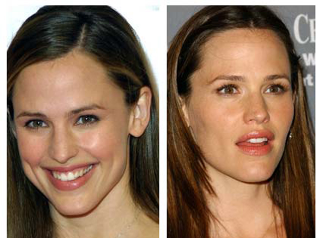 Jennifer Garner Nose Job Plastic Surgery Before and After