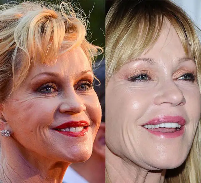 Melanie Griffith Facelift Plastic Surgery Before and After