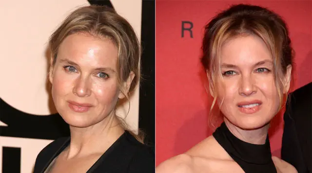 Renee Zellweger Plastic Surgery Before and After Botox Injections