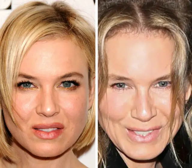 Renee Zellweger Plastic Surgery Before and After Botox