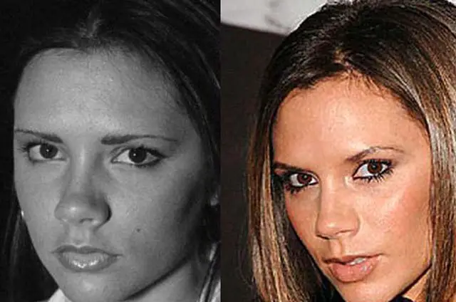 Victoria Beckham Nose Job Plastic Surgery Before and After.