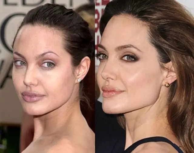 Angelina Jolie Plastic Surgery Before and After Botox Injections