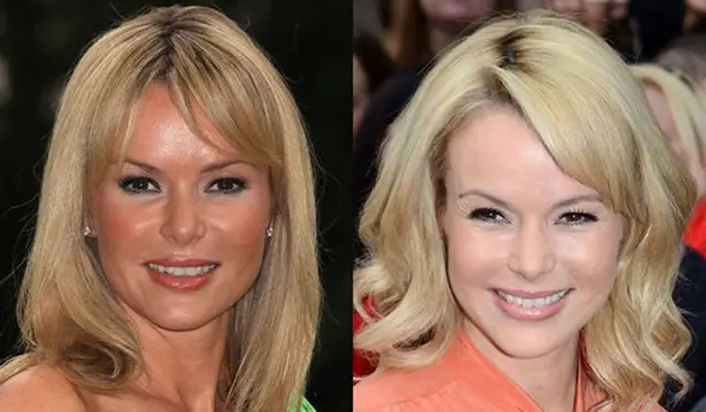 Amanda Holden Plastic Surgery Before and After Botox Injections