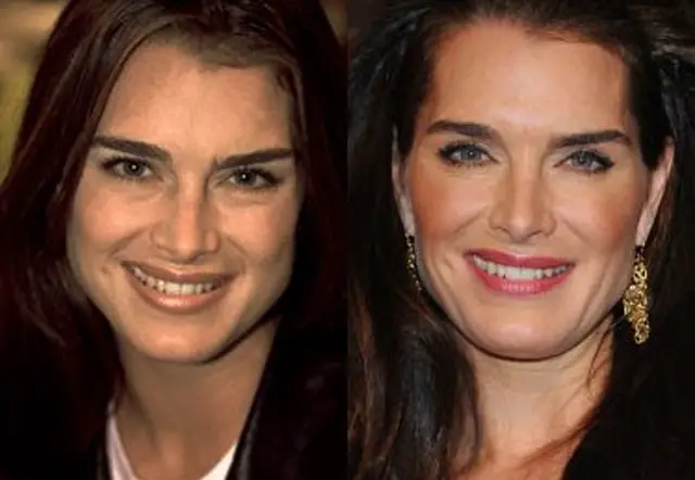 Brooke Shields Plastic Surgery Before and After Botox Injections
