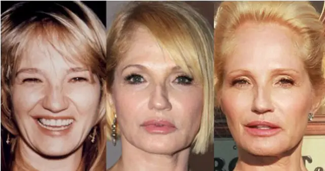Ellen Barkin Facelift Plastic Surgery Before and After