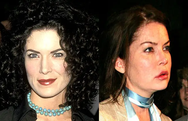 Lara Flynn Boyle Plastic Surgery Before and After Botox Injections