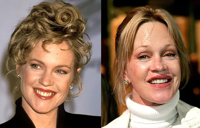 Melanie Griffith Plastic Surgery Before and After Botox Injections
