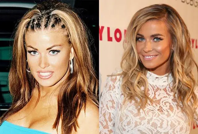 Carmen Electra Plastic Surgery Before and After Botox Injections
