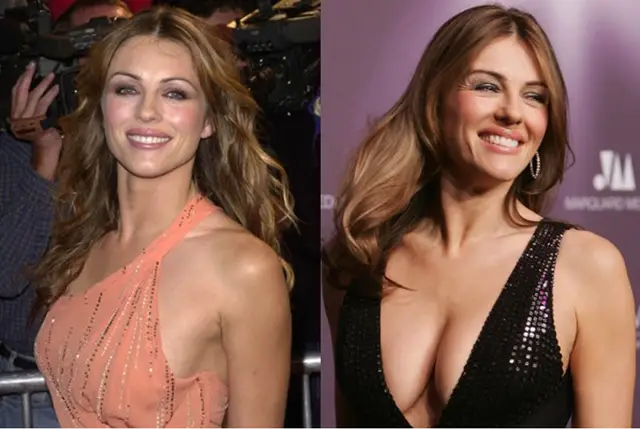 Elizabeth Hurley Breast Augmentation Plastic Surgery Before and After