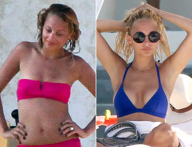 Nicole Richie Breast Augmentation Plastic Surgery Before and After