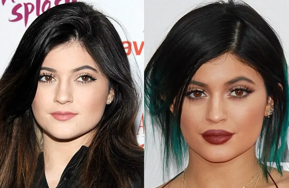 Kylie Jenner Plastic Surgery Before and After.