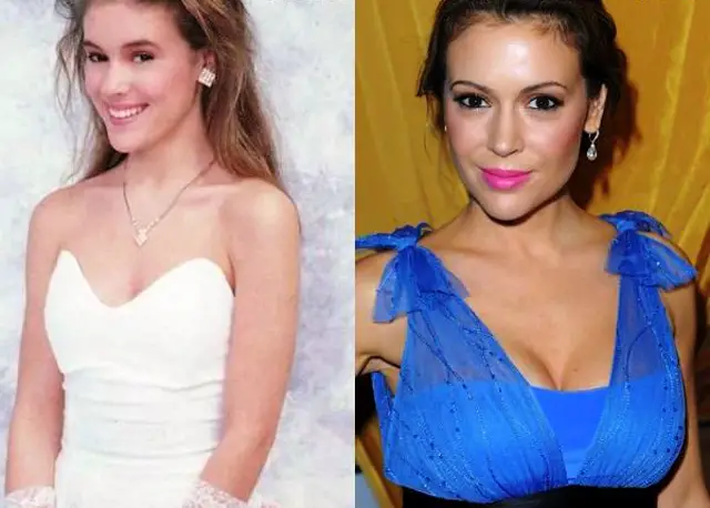 Alyssa Milano Breast Augmentation Plastic Surgery Before and After