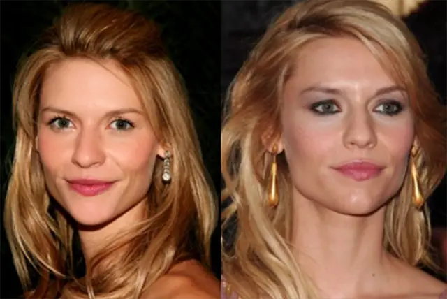 Claire Danes Plastic Surgery Before and After