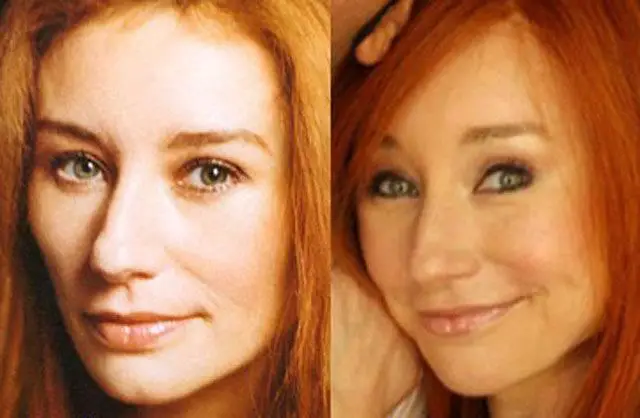 Tori Amos Plastic Surgery Before and After