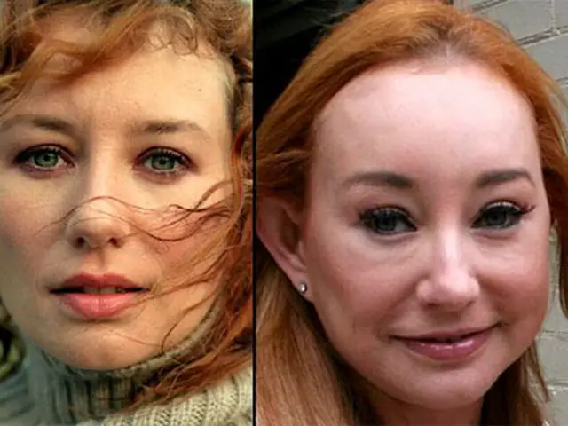 Tori Amos Plastic Surgery Before and After