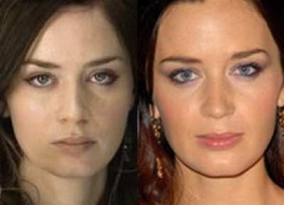 Emily Blunt Plastic Surgery Before And After Celebie