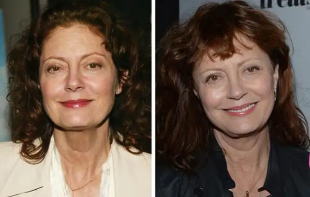 Susan Sarandon Plastic Surgery