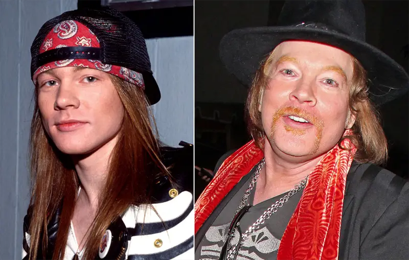 Axl Rose Plastic Surgery