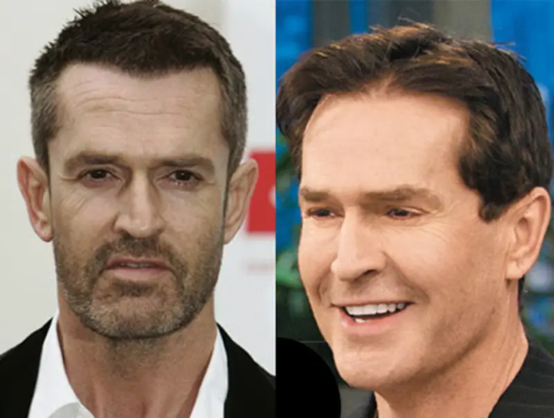 Rupert Everett Plastic Surgery Before and After