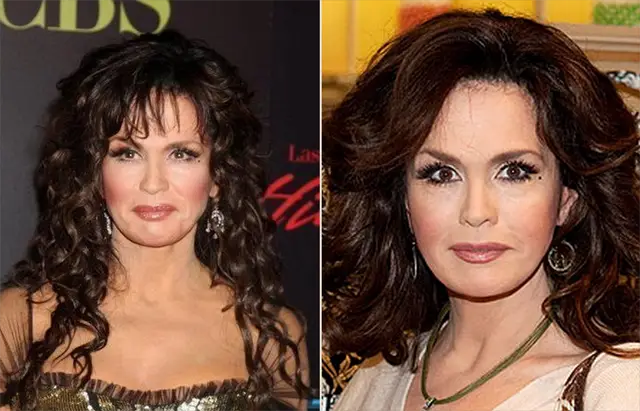 Marie Osmond Plastic Surgery Before and After