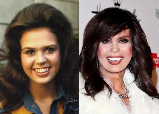 Marie Osmond Plastic Surgery Before and After