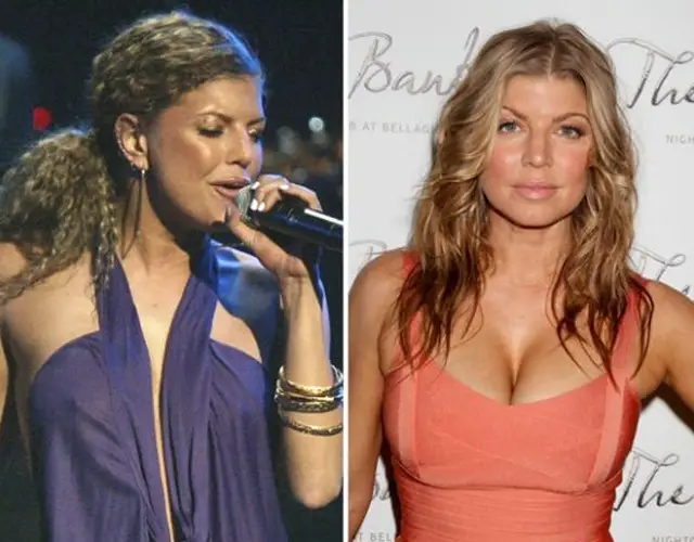 Fergie Breast Augmentation Plastic Surgery